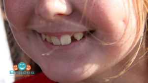 Barrhaven Orthodontist - how to tell if your child needs braces